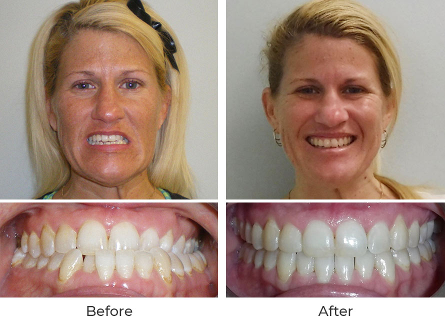 before and after braces adults